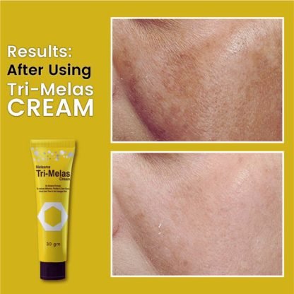 Tri Melas Cream By Dr Romia (3)